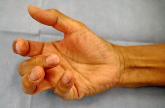 スマホ使い過ぎ 腱鞘炎からばね指に 手術も選択肢 ヘルスｕｐ Nikkei Style