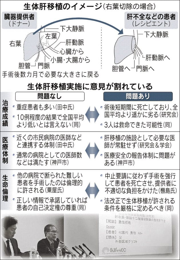 神戸の病院で術後患者相次ぎ死亡 生体肝移植巡り論争 Nikkei Style 神戸の病院で術後患者相次ぎ死亡 生体肝移植巡り論争 Nikkei Style