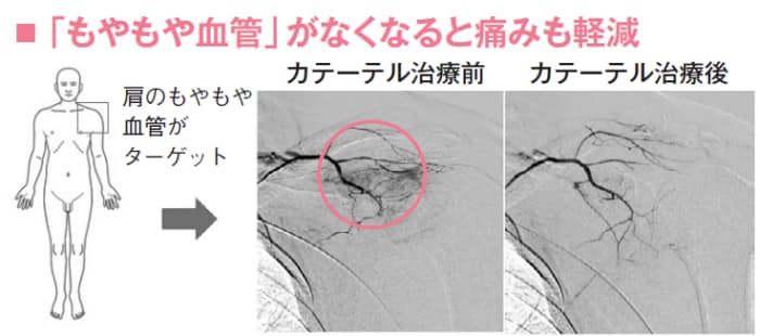 原因不明のしつこい痛み 犯人は もやもや血管 かも Nikkei Style 原因不明のしつこい痛み 犯人は もやもや血管 かも Nikkei Style