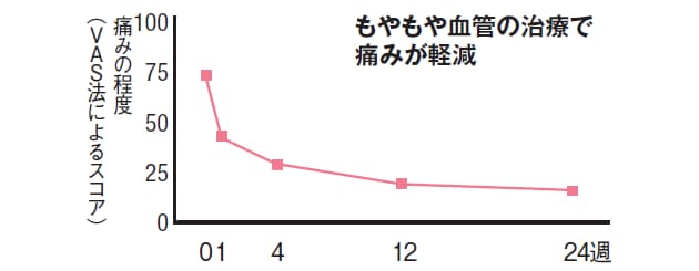 原因不明のしつこい痛み 犯人は もやもや血管 かも Nikkei Style 原因不明のしつこい痛み 犯人は もやもや血管 かも Nikkei Style