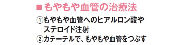 原因不明のしつこい痛み 犯人は もやもや血管 かも Nikkei Style 原因不明のしつこい痛み 犯人は もやもや血管 かも Nikkei Style