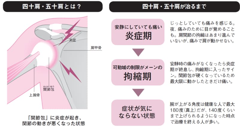 ストレッチと抗炎症薬で早く治す四十肩 五十肩 Nikkei Style ストレッチと抗炎症薬で早く治す四十肩 五十肩 Nikkei Style