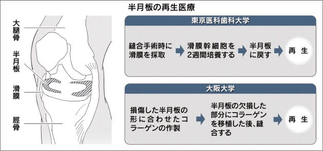 半月板損傷に光 患者の細胞から 牛のコラーゲン活用 Nikkei Style