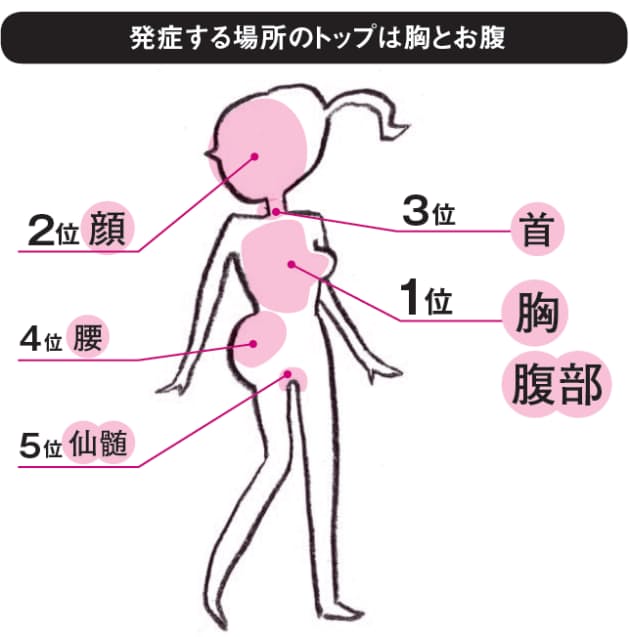 体の片側に激痛と発疹 50代で急増する帯状疱疹 Nikkei Style