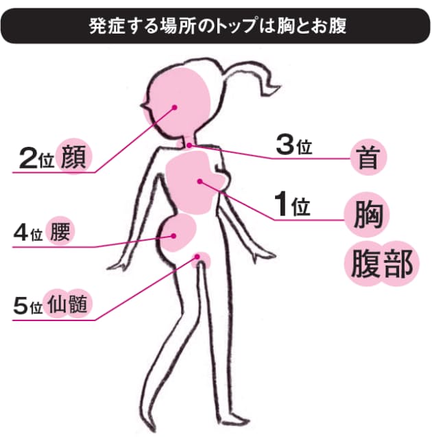 体の片側に激痛と発疹 50代で急増する帯状疱疹 Nikkei Style 体の片側に激痛と発疹 50代で急増する帯状疱疹 Nikkei Style
