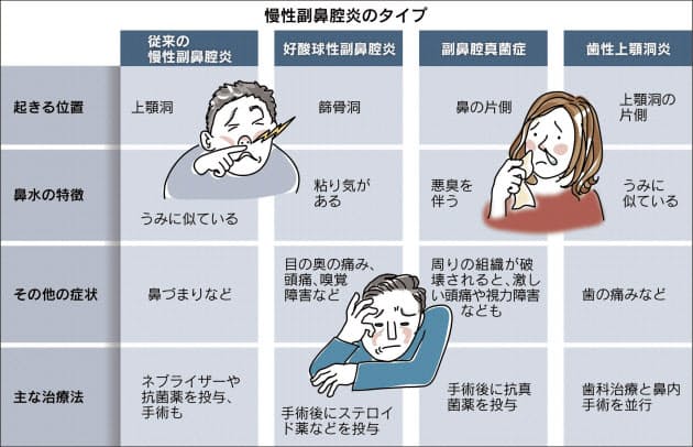 つら い慢性副鼻腔炎 タイプ様々 適切な治療を Nikkei Style