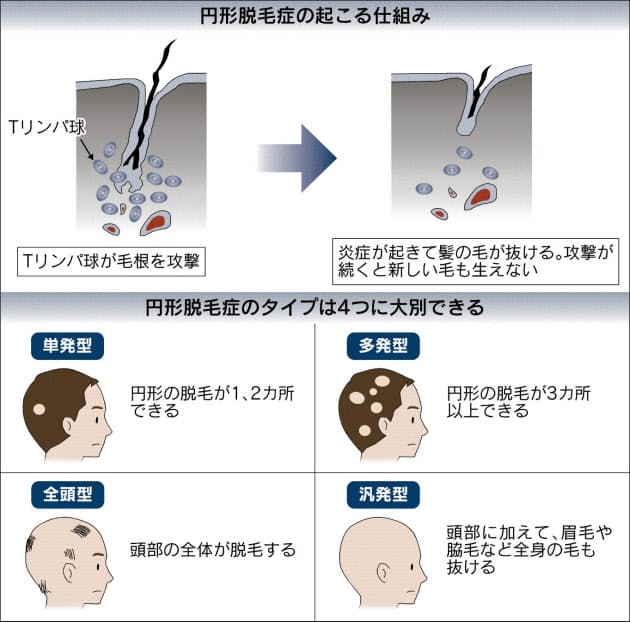 突然現れて驚く円形脱毛症 免疫異常が原因 Nikkei Style