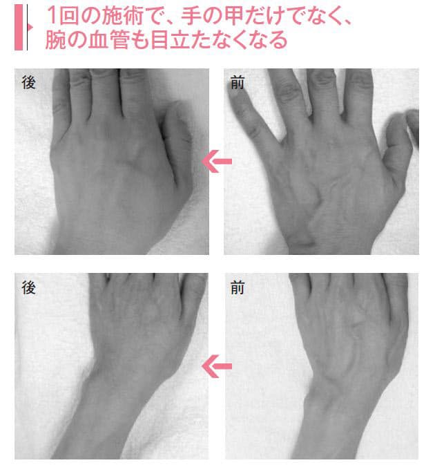 手の甲に浮き出た血管 レーザー治療できれいに Nikkei Style