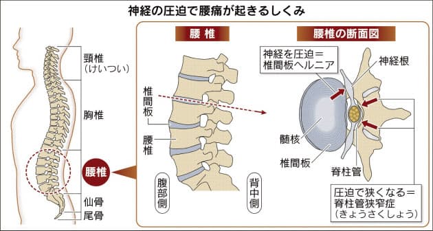 ちょっと待った 腰痛手術 保存治療で改善のケースも Nikkei Style