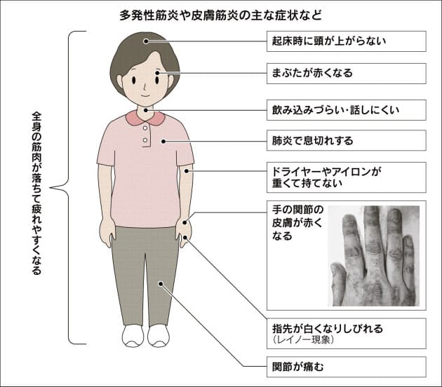 性 と 多発 は 筋炎