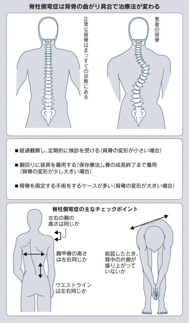 脊柱側弯症 成長期に用心 背骨曲がり重度で手術 Nikkei Style