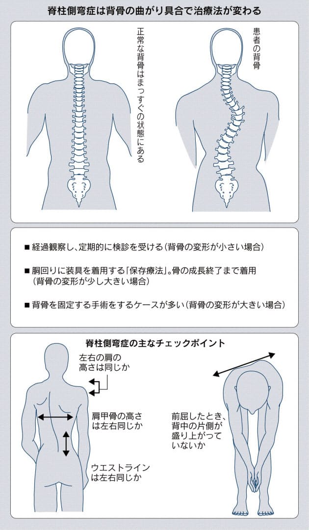 湾曲 症 脊柱