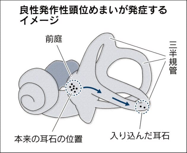 仰向け で 寝る と めまい が する