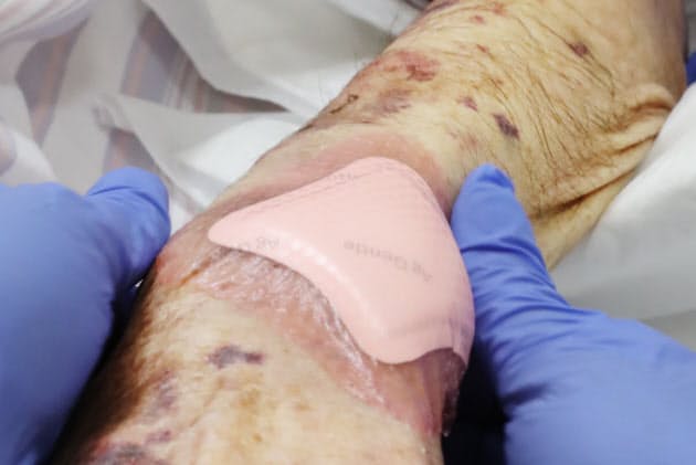 高齢者の皮膚の スキンテア 摩擦やずれでけが Nikkei Style 高齢者の皮膚の スキンテア 摩擦やずれでけが Nikkei Style