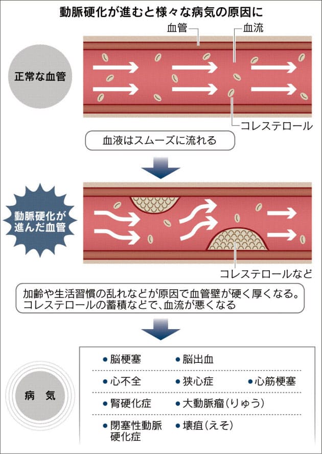 血管年齢 知って病気の芽を摘む Nikkei Style 血管年齢 知って病気の芽を摘む Nikkei Style