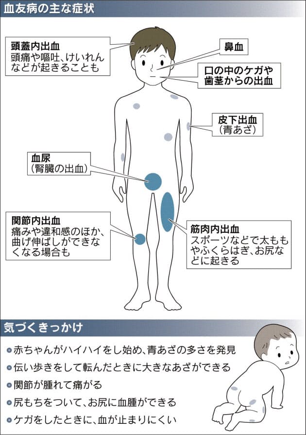 血友病 新薬で負担軽減 注射は週4回から2回に Nikkei Style