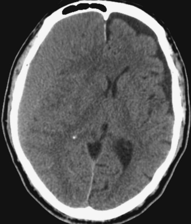 急な頭痛やマヒ 認知症 慢性硬膜下血腫を疑って Nikkei Style 急な頭痛やマヒ 認知症 慢性硬膜下血腫を疑って Nikkei Style