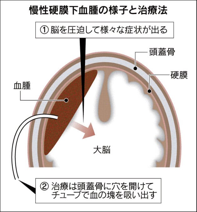 急な頭痛やマヒ 認知症 慢性硬膜下血腫を疑って Nikkei Style 急な頭痛やマヒ 認知症 慢性硬膜下血腫を疑って Nikkei Style