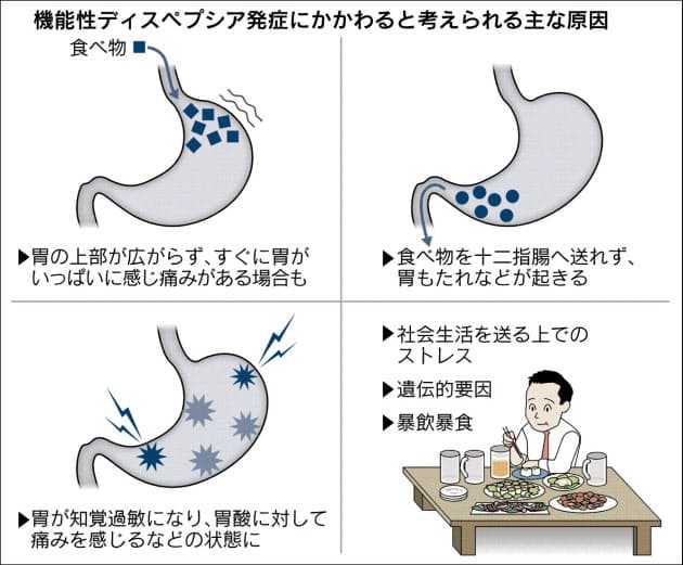 長引く胃もたれ 機能性胃腸症の可能性も ヘルスｕｐ Nikkei Style