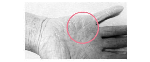 むける 手のひら 原因 皮 指の皮がむける原因とは？７つの原因と３つの病気の可能性について