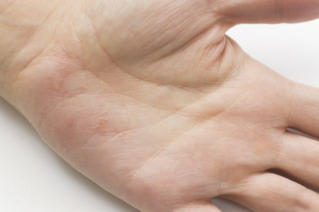 手足の湿疹長引いたら 金属アレルギーかも ヘルスｕｐ Nikkei Style