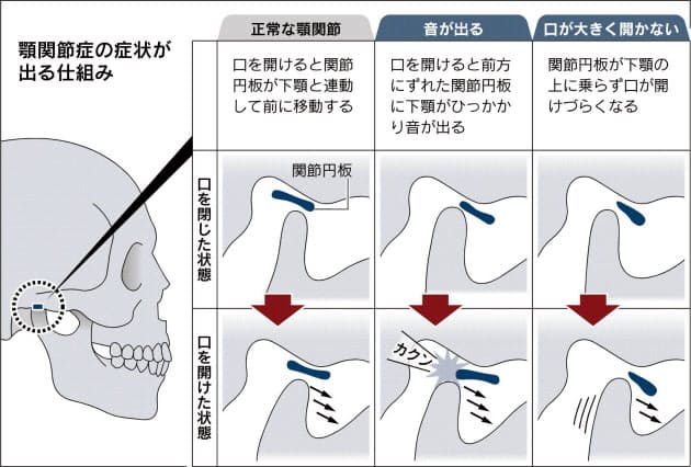 顎関節症 習慣変えて治す Nikkei Style