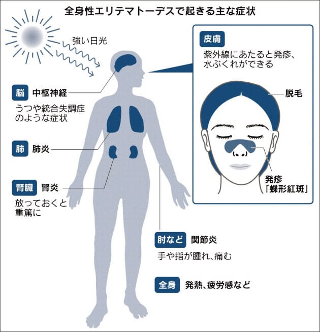 春の日焼け 発疹 実は難病 うつや腎炎の恐れも Nikkei Style