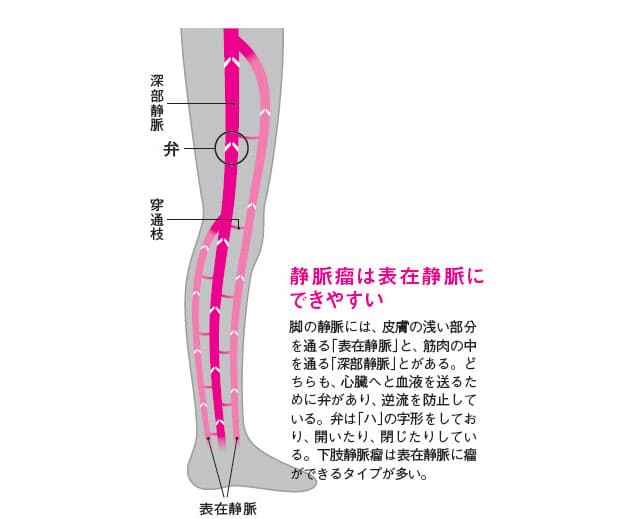 立ち仕事の多い人は注意 血管浮き出る 下肢静脈瘤 Nikkei Style