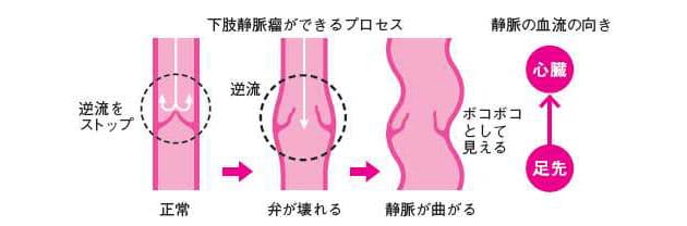 下肢 静脈 瘤 自分 で 治す 治す 瘤 で 下肢 自分 静脈