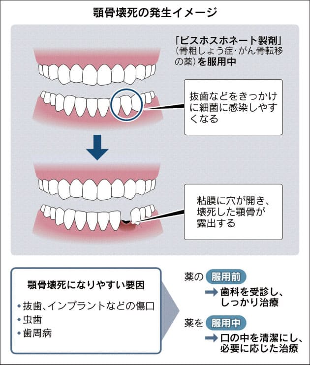 骨粗しょう症薬 使用に留意 副作用で顎の骨壊死 ヘルスｕｐ Nikkei