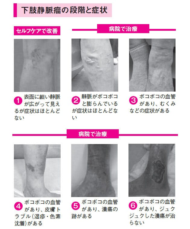 かかとの上げ下げが効果的 下肢静脈瘤のセルフケア Nikkei Style