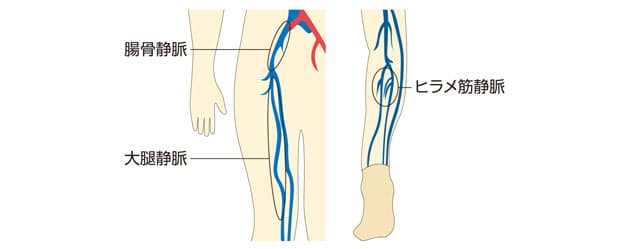 大きな血栓は突然死を招くことも 長時間フライト時はご用心 不調予防に水分補給を Nikkei Style 大きな血栓は突然死を招くことも 長時間フライト時はご用心 不調予防に水分補給を Nikkei Style