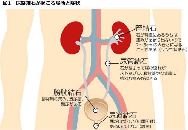 方法 早く 管 尿 結石 出す