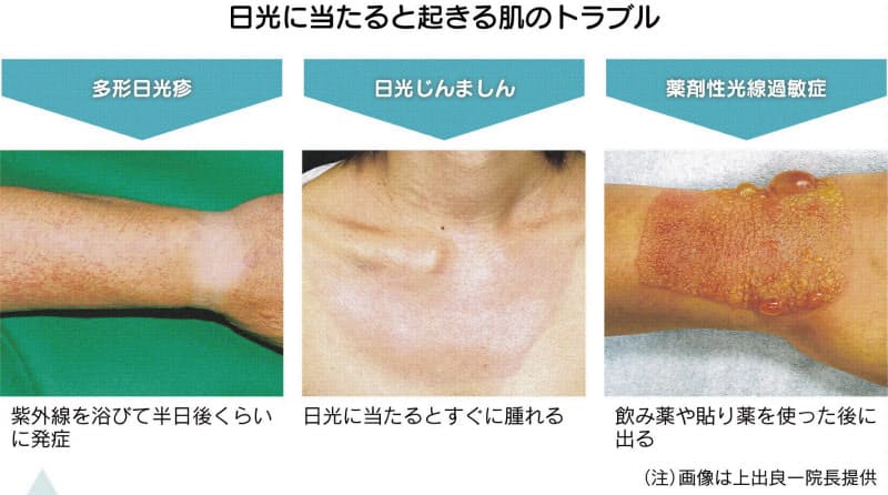 夏の肌トラブル 意外に多い 光線過敏症 って Nikkei Style