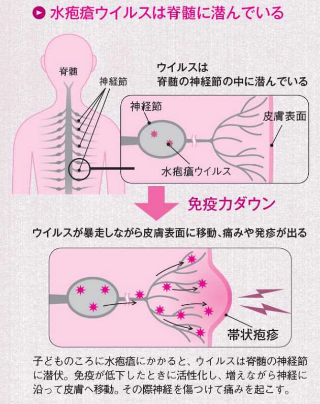 じわり増加 帯状疱疹 50歳以上の女性はご用心 Nikkei Style じわり増加 帯状疱疹 50歳以上の女性はご用心 Nikkei Style