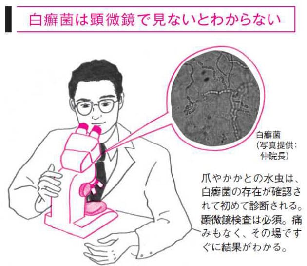 かかとガサガサ 爪が白濁 放置に注意 慢性水虫かも Nikkei Style かかとガサガサ 爪が白濁 放置に注意 慢性水虫かも Nikkei Style