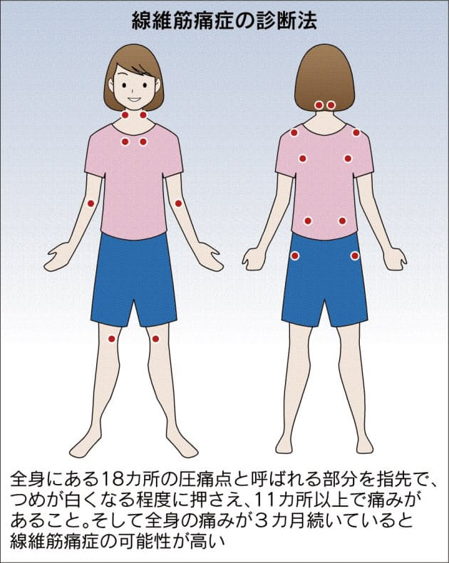 その痛み 線維筋痛症 原因不明 中高年女性に多く Nikkei Style