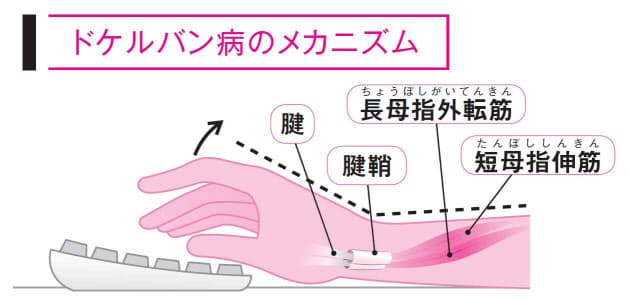 親指や手首がピリッ！ その痛み、スマホのせいかも？｜ヘルスＵＰ ...