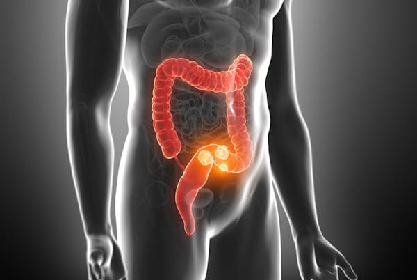 飲酒、喫煙、肥満、運動不足、感染症…。どれが確実に大腸がんのリスクを高めるでしょう。画像はイメージ=(c)Sebastian Kaulitzki-123RF 飲酒、喫煙、肥満、運動不足、感染症…。どれが確実に大腸がんのリスクを高めるでしょう。画像はイメージ=(c)Sebastian Kaulitzki-123RF