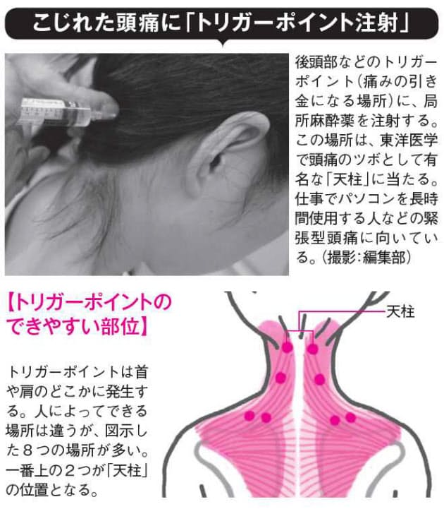 薬も効かない こじれた頭痛 局所注射と漢方が効く Nikkei Style
