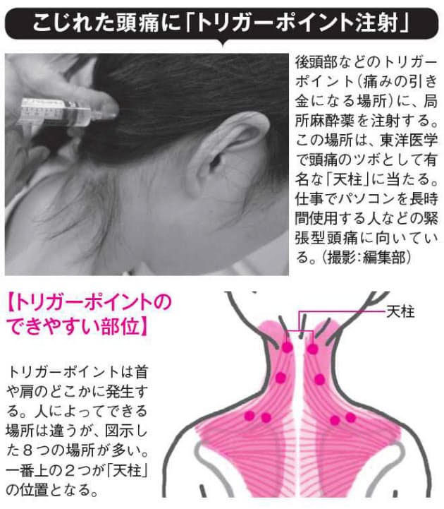 場所 頭痛 痛みを感じるのはどこ？頭痛を感じる場所から見る症状とその原因