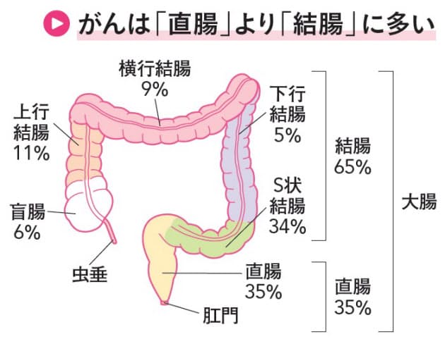 直腸 が ん 症状