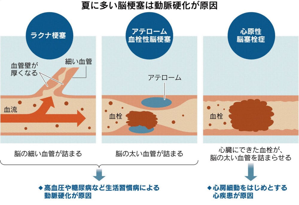 血栓 性 梗塞 アテローム 脳