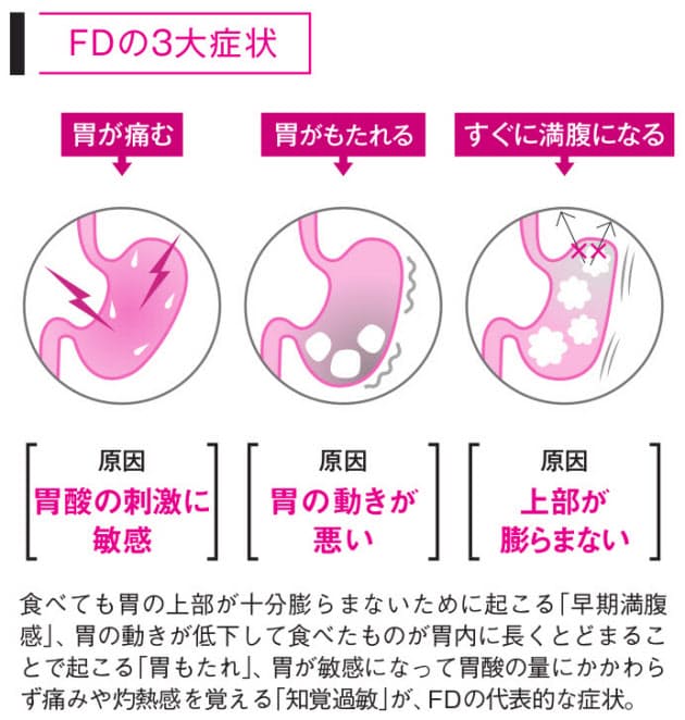 内視鏡で異常なし なぜか続く胃の不快感の原因は Nikkei Style