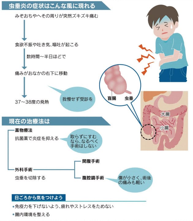 急なズキズキ 盲腸かも 早期発見なら手術いらず Nikkei Style