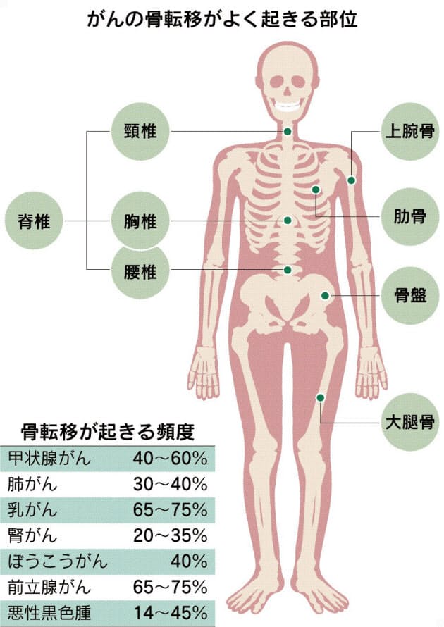 骨 転移 症状