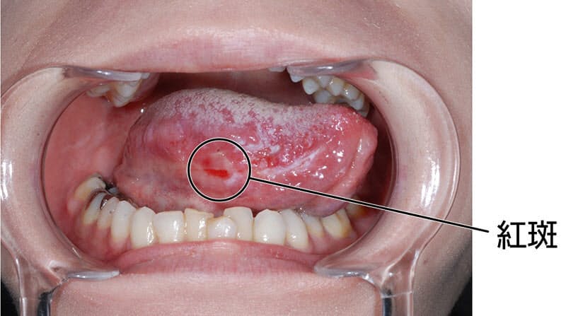の 裏側 に 口内炎 舌