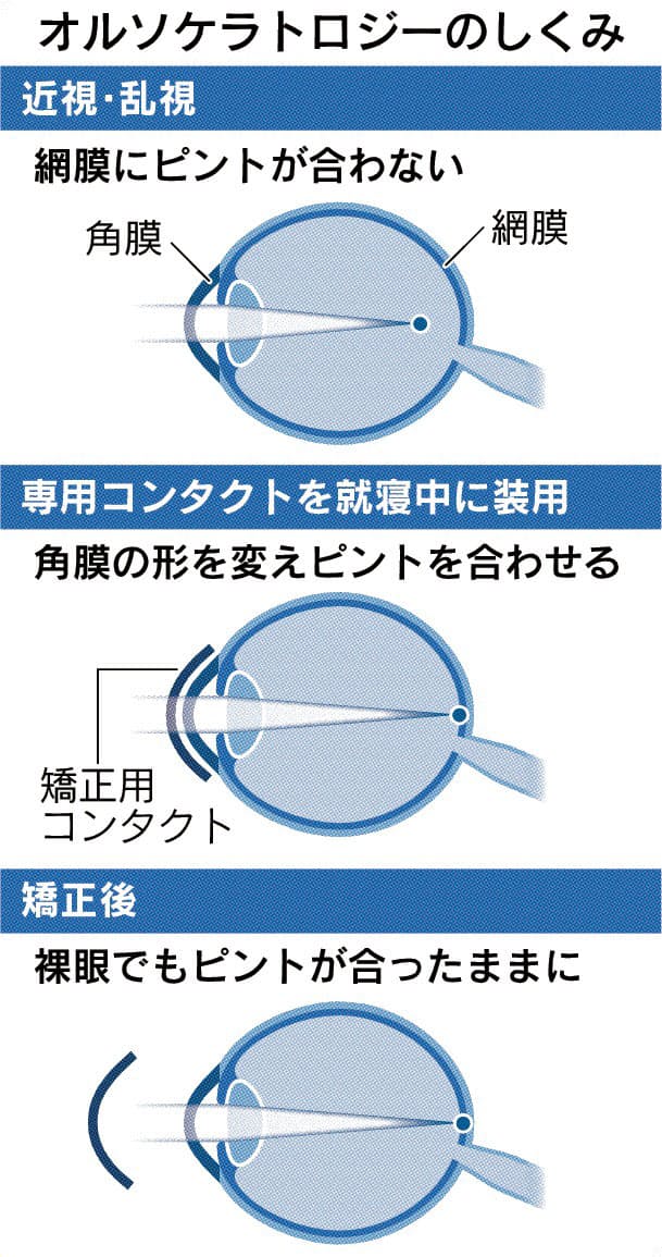 寝ている間に視力矯正 特殊コンタクト治療の注意点 Nikkei Style