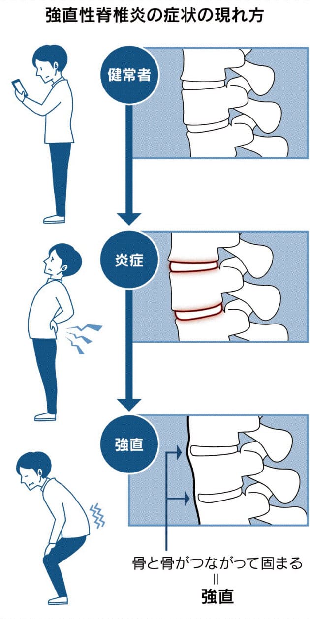 病名確定に平均10年 未成年も発症多く 骨が固まる難病 強直性脊椎炎 新薬 Nikkei Style 病名確定に平均10年 未成年も発症多く 骨が固まる難病 強直性脊椎炎 新薬 Nikkei Style