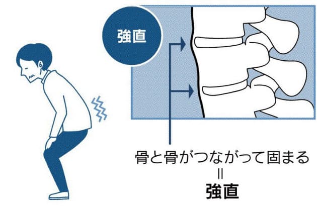 骨が固まる難病 強直性脊椎炎 新薬に期待 Nikkei Style 骨が固まる難病 強直性脊椎炎 新薬に期待 Nikkei Style